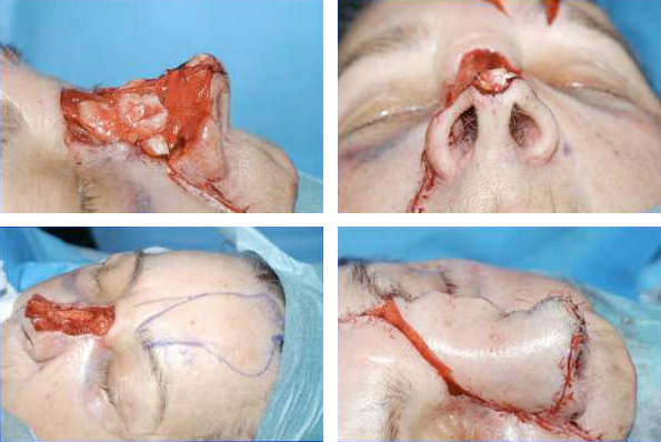 Rhinectomy - Lining flaps and cartilage grafts