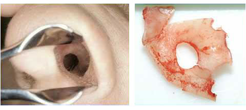 Septal Perforation - Cocaine Nose Injury