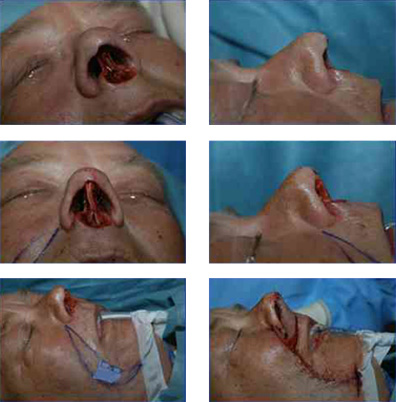 Columella Reconstruction Surgery