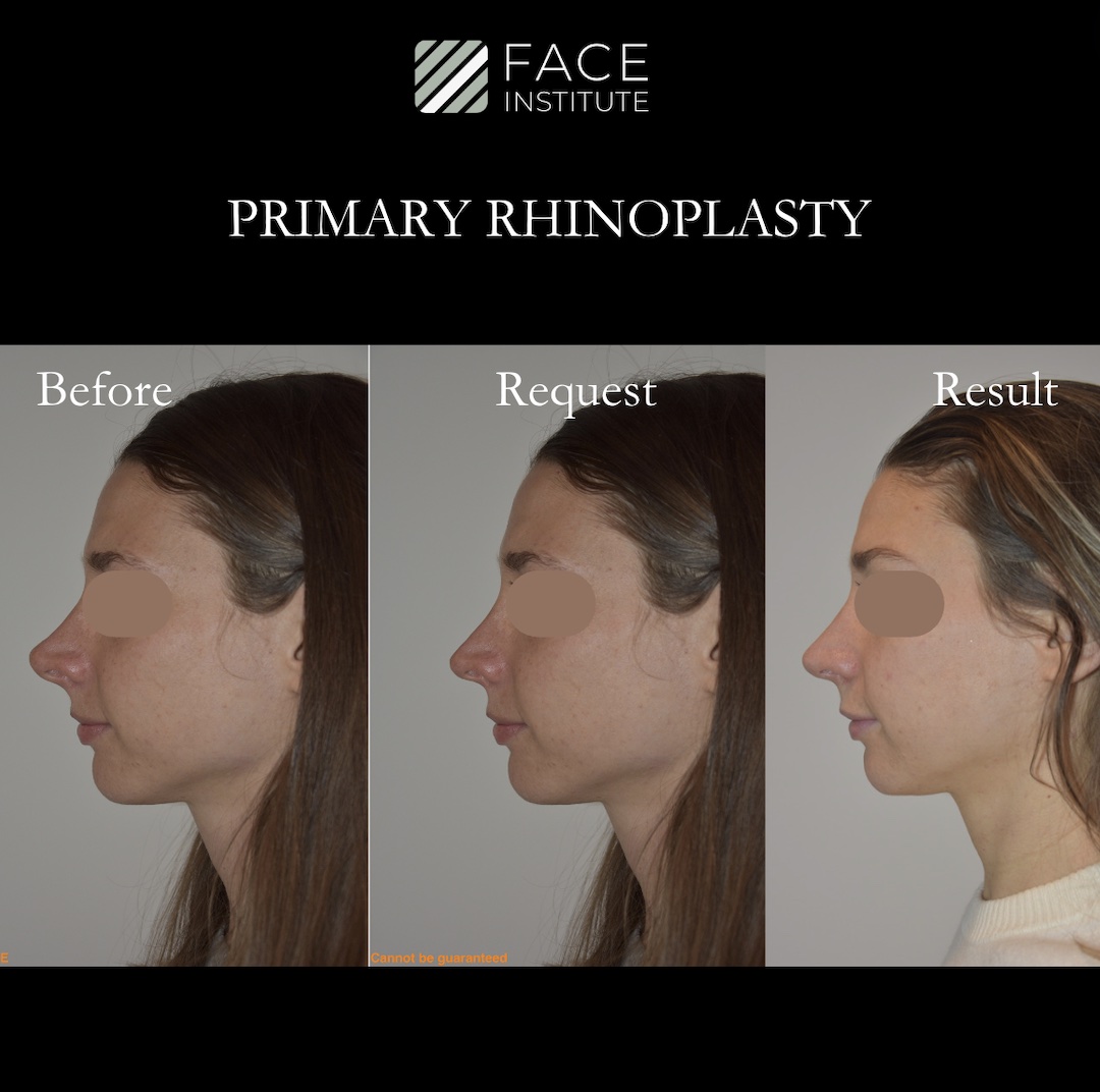 Primary Rhinoplasty 1A