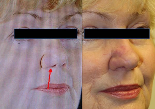 Rhinoplasty and refining techniques
