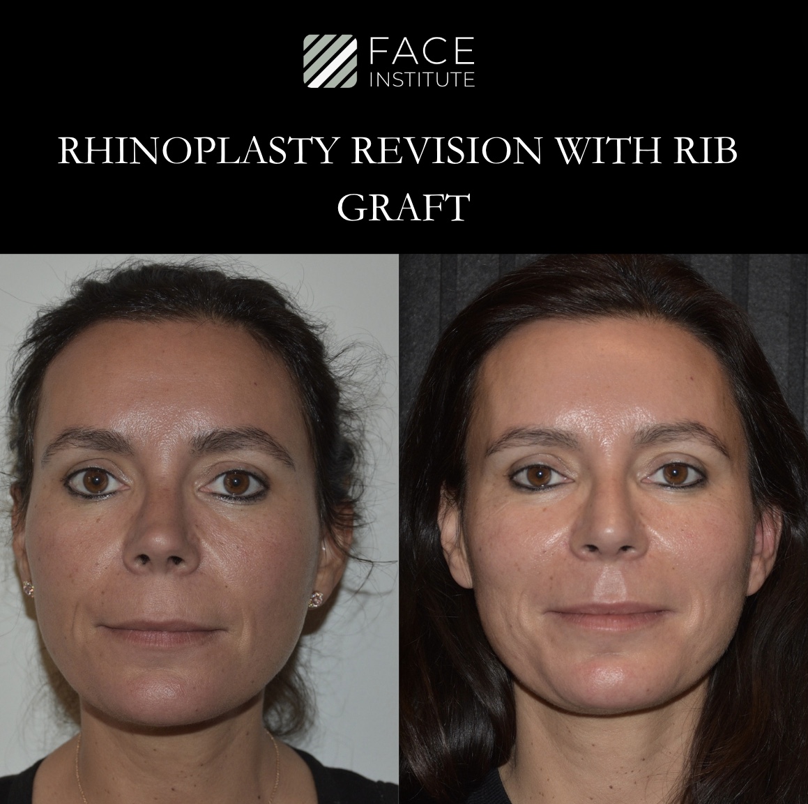 Revision Rhinoplasty 7C