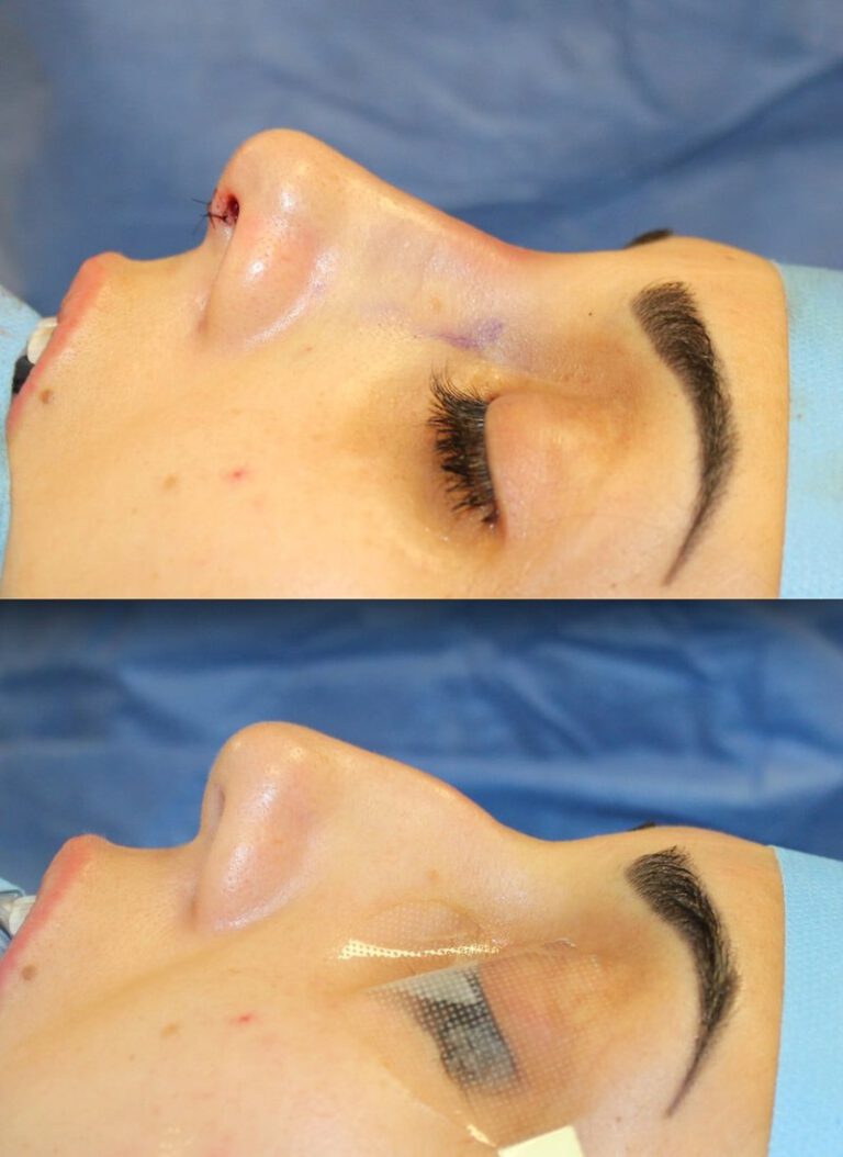 Rhinoplasty before and after surgery