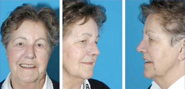 Large defect into the nose and sub total reconstruction
