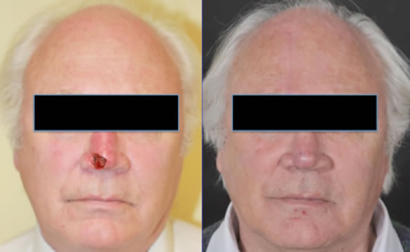 Skin and cartilage defect of half of the nasal tip. Reconstructed with a 3 stage forehead flap results in a symmetrical nose with normal nasal breathing, no nostril narrowing or retraction.