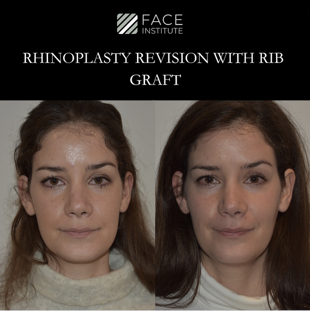 Revision Rhinoplasty 5 B