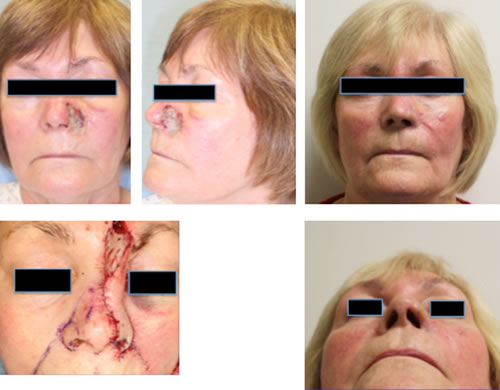 Moderate nose reconstruction