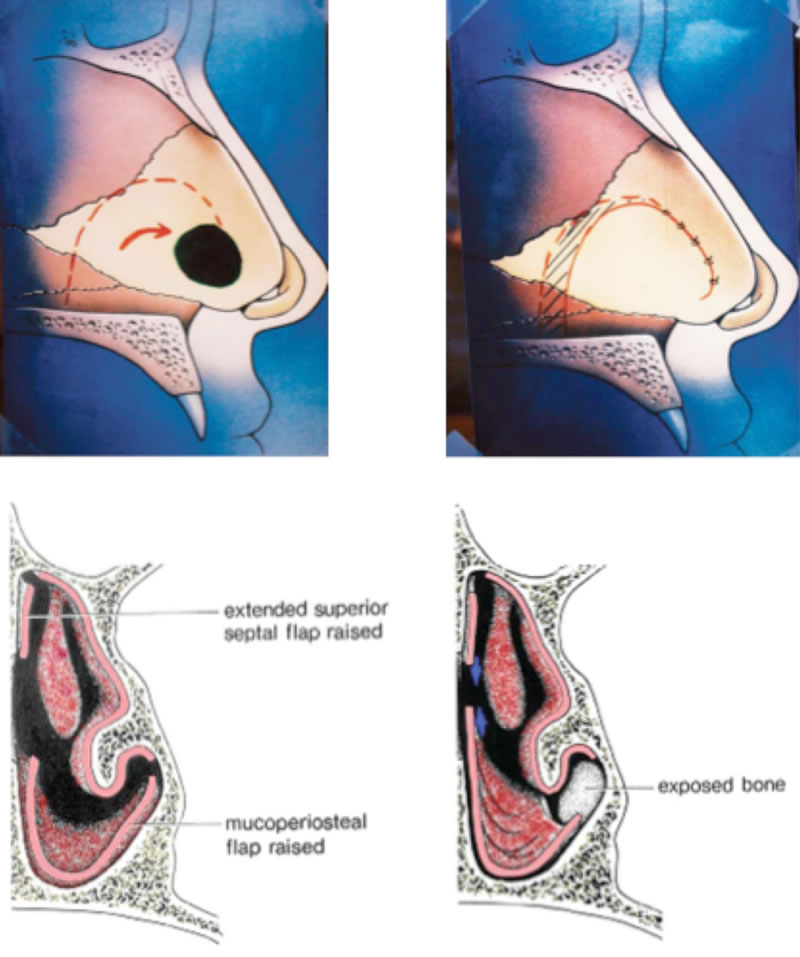 Types of Septal perforations
